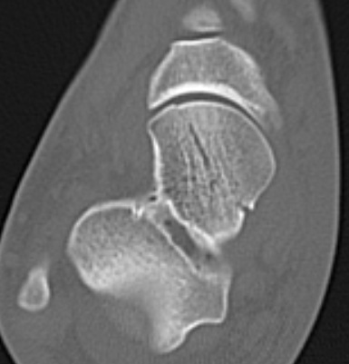 Talar Head Fracture CT